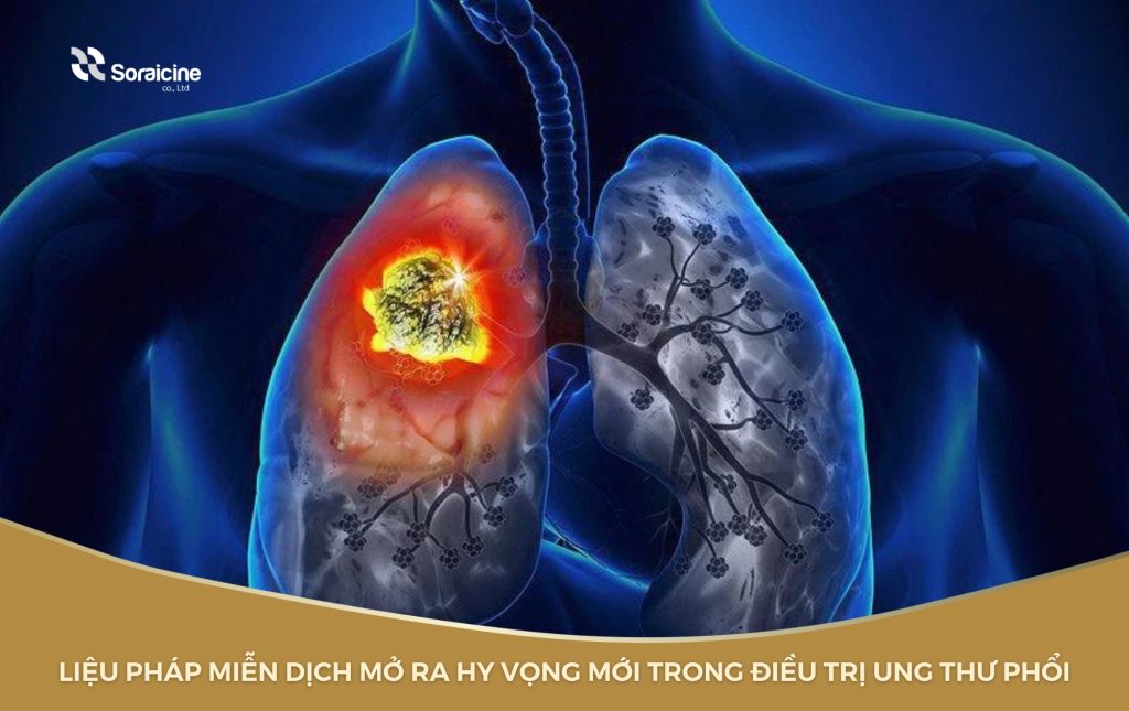 Điều trị miễn dịch ung thư phổi là liệu pháp mới, đem lại hiệu quả cao trong điều trị