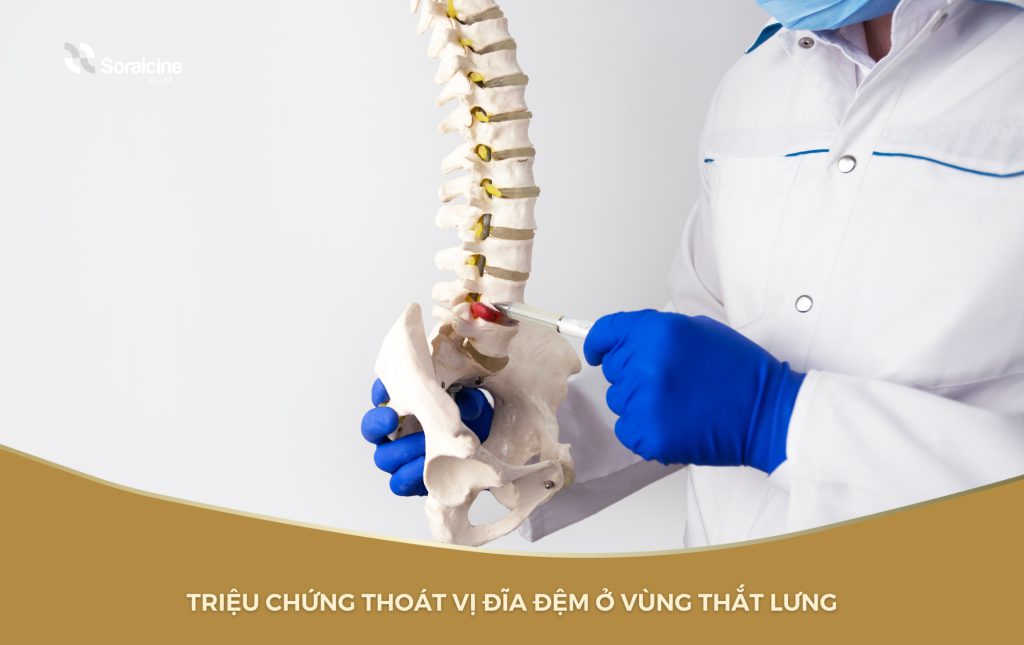 Triệu chứng thoát vị đĩa đệm thắt lưng bao gồm: đau thắt lưng, đau lan rộng và gia tăng, làm mất kiểm soát cơ thể,...